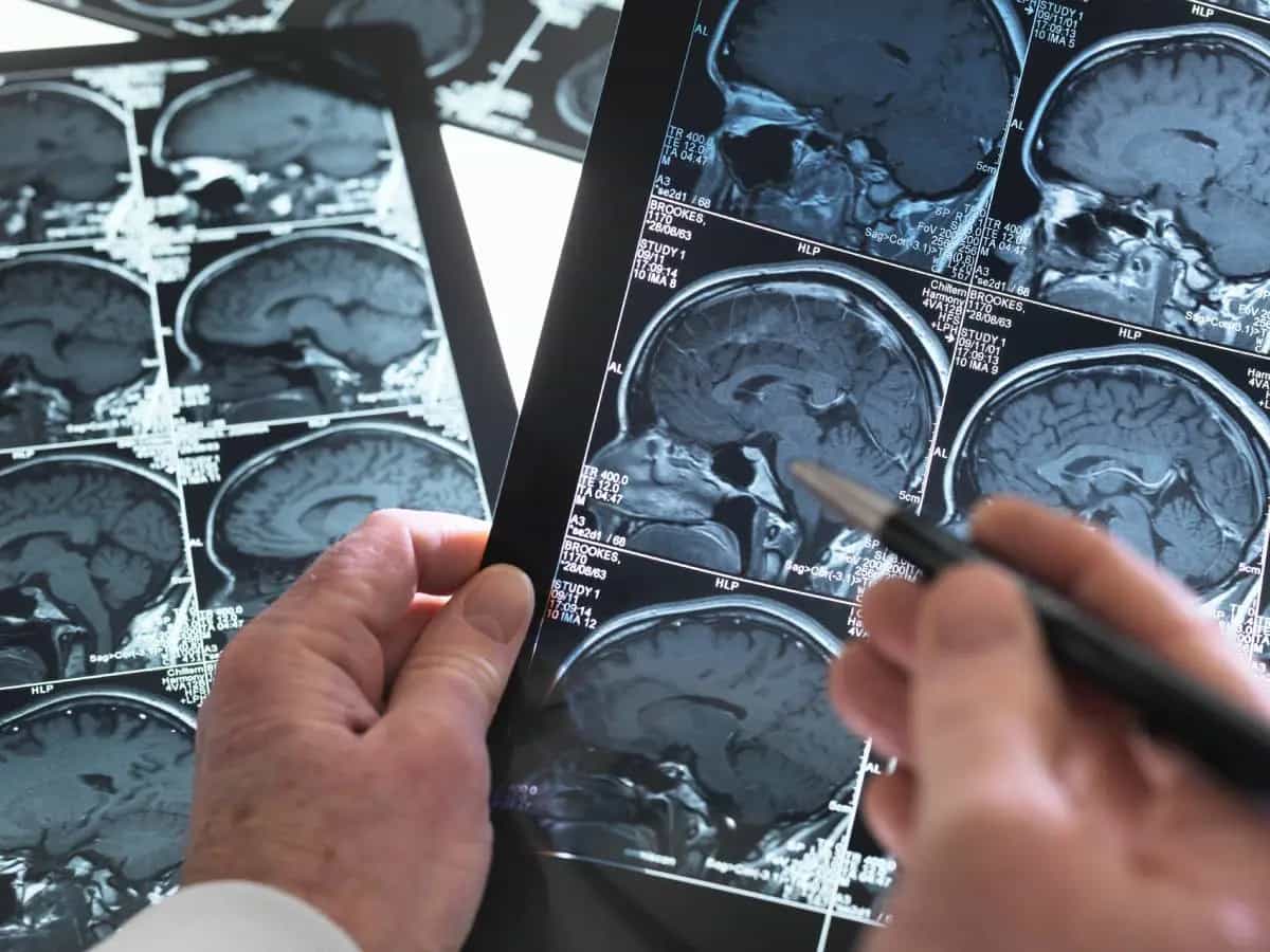 Microplastiche, ormai sono anche nel cervello umano